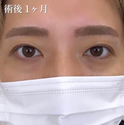 ダウンタイムの経過写真 術後1ヶ月