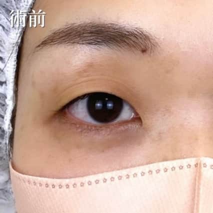 術前