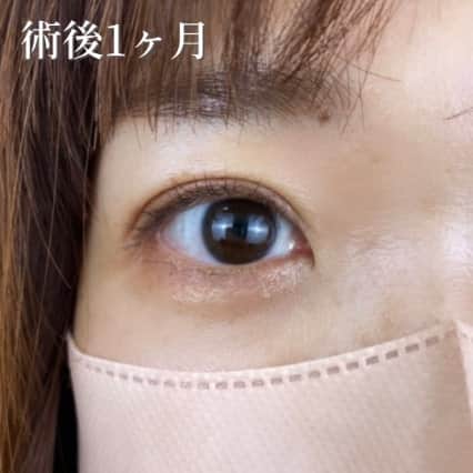術後