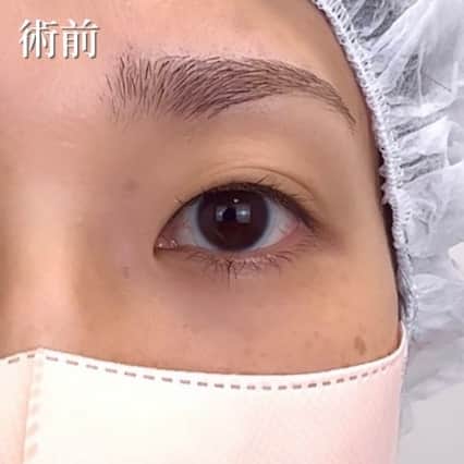 術前
