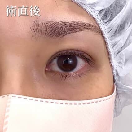術直後