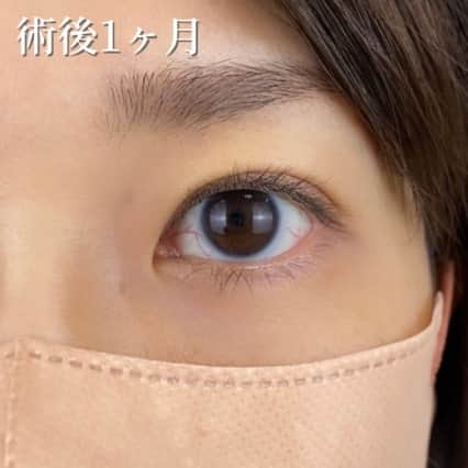 術後
