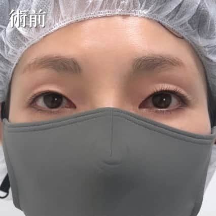 術前