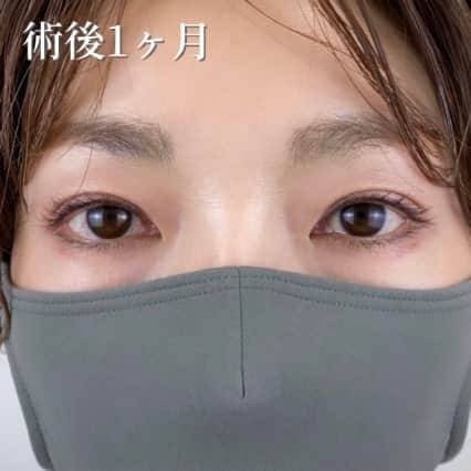 術後