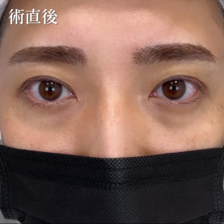 ダウンタイムの経過写真 術直後
