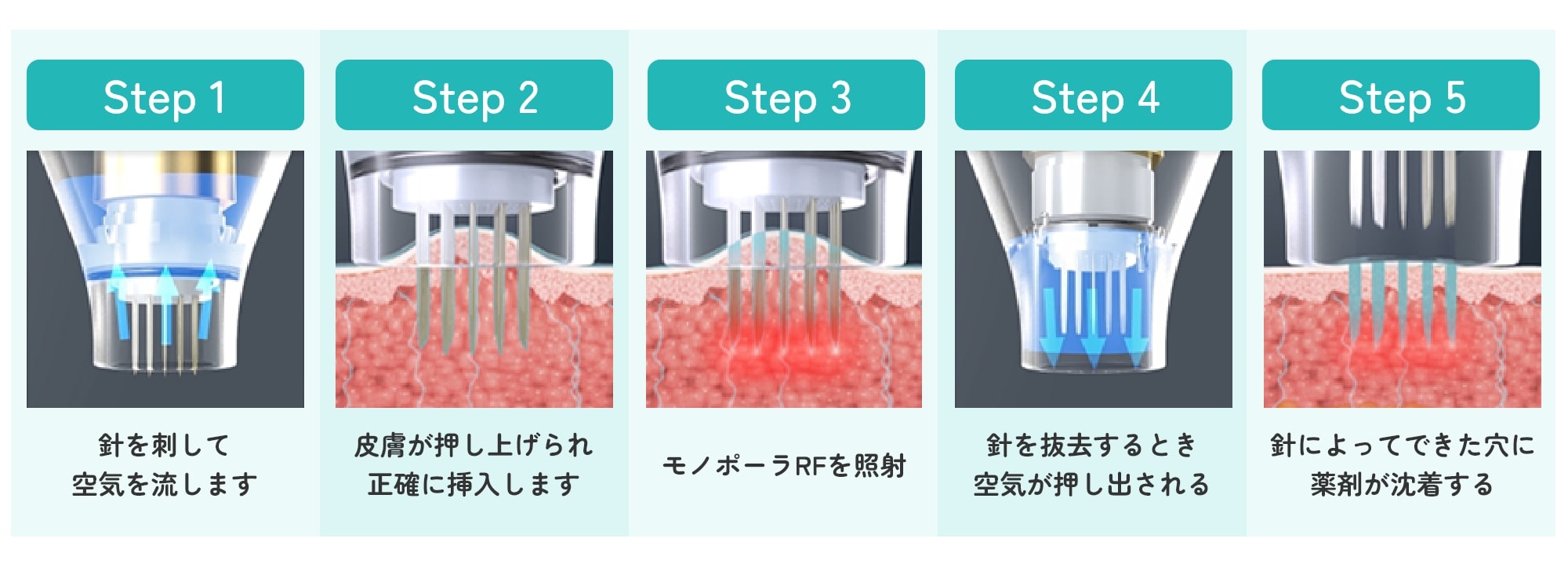 ドラックデリバリーのステップ