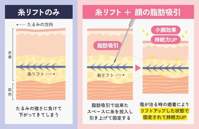 糸リフトの併用で小顔効果と持続力アップ