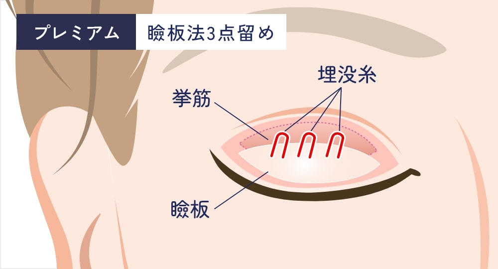 瞼板法3点留め