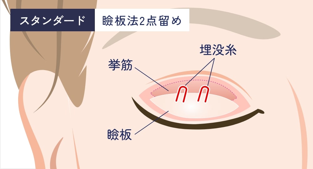 瞼板法2点留め