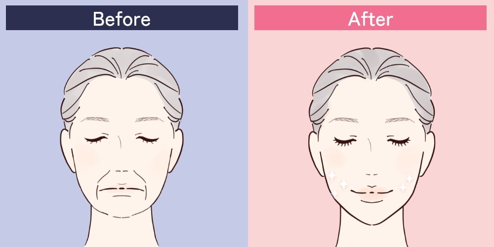 ヒアルロン酸注射によるほうれい線の改善