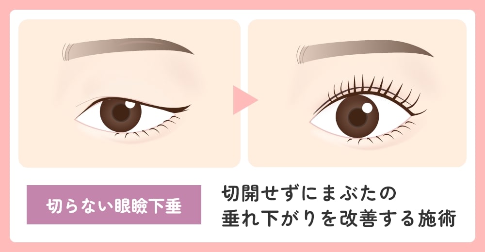 切らない眼瞼下垂