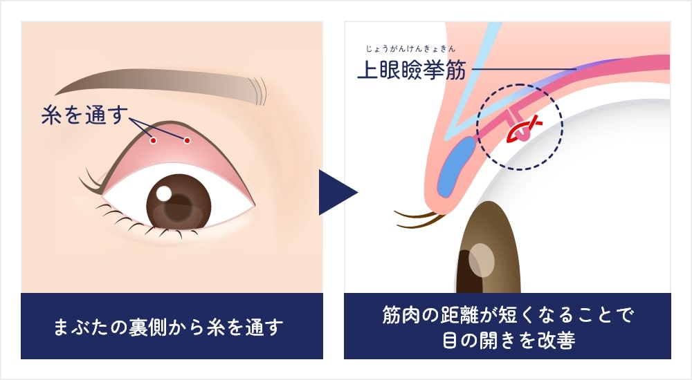 切らない眼瞼下垂の施術イメージ