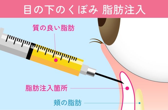 目の下の脂肪注入