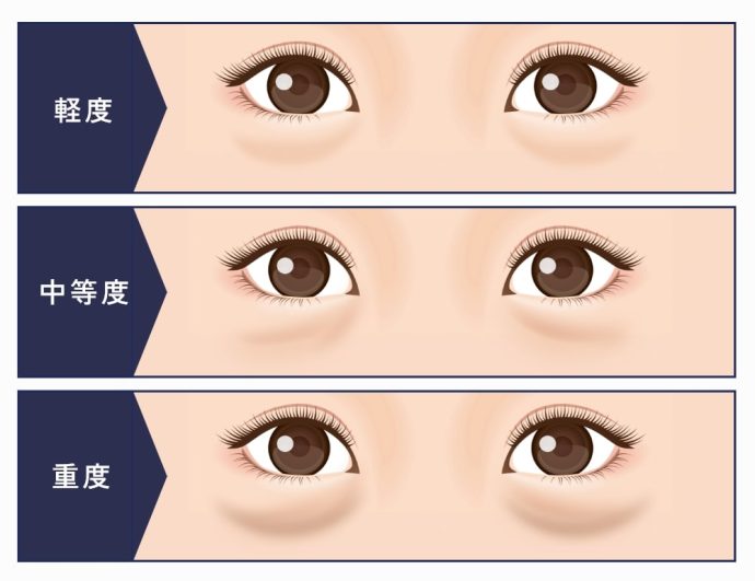 眼瞼脂肪の症状