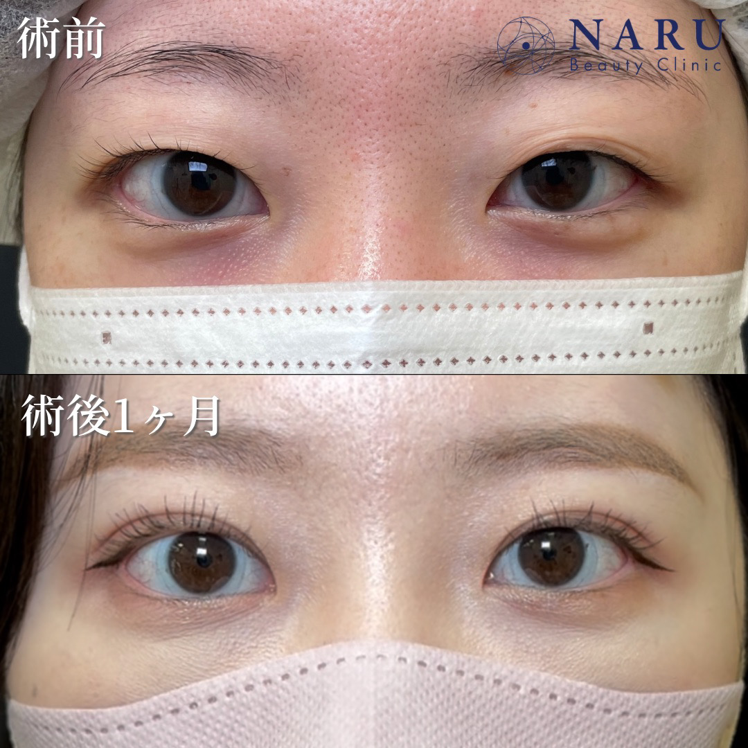 20代女性【二重埋没法】No.90 - NARU Beauty Clinic(ナルクリ) 千葉院 | 美容外科・美容皮膚科
