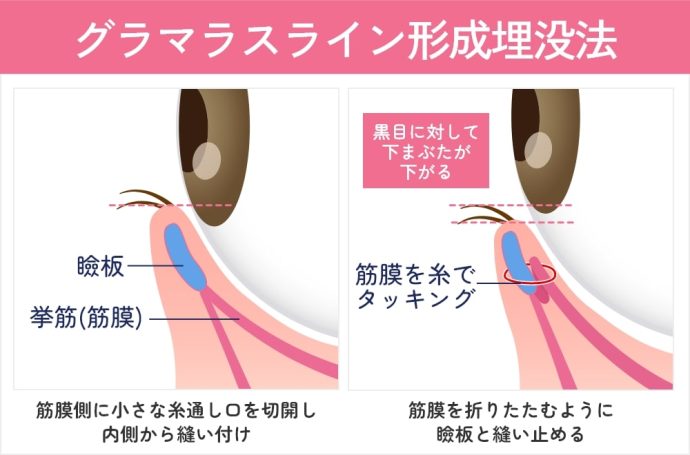 グラマラスライン形成図