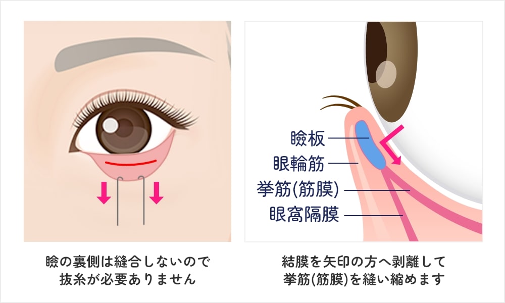 グラマラスライン形成切開図