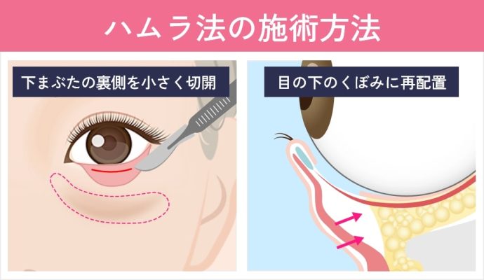 ハムラ法の施術方法