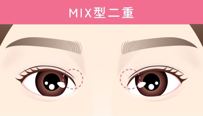 MIX型二重