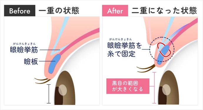 切らない眼瞼下垂