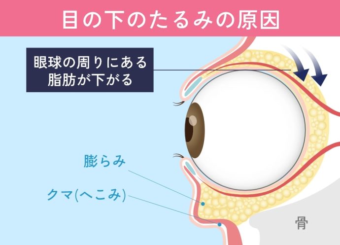 目の下のたるみの原因