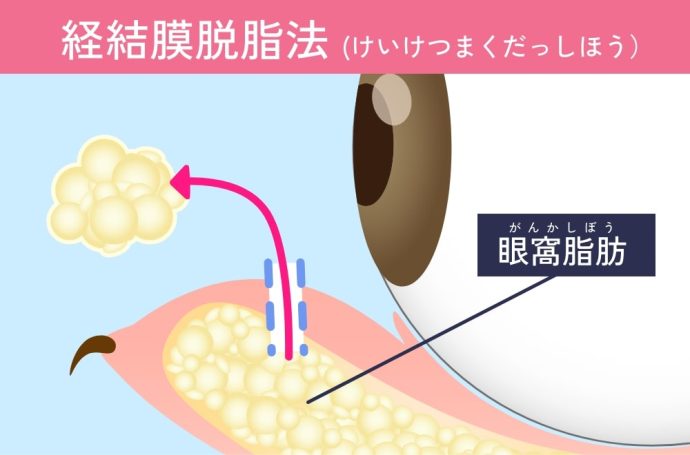 経結膜脱脂法