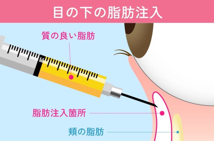 目の下の脂肪注入