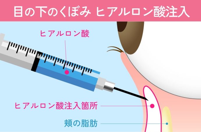 目の下のヒアルロン酸注入