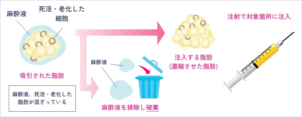 太ももから採取した脂肪を濃縮