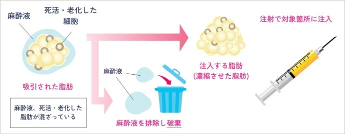 おでこの脂肪注入の方法