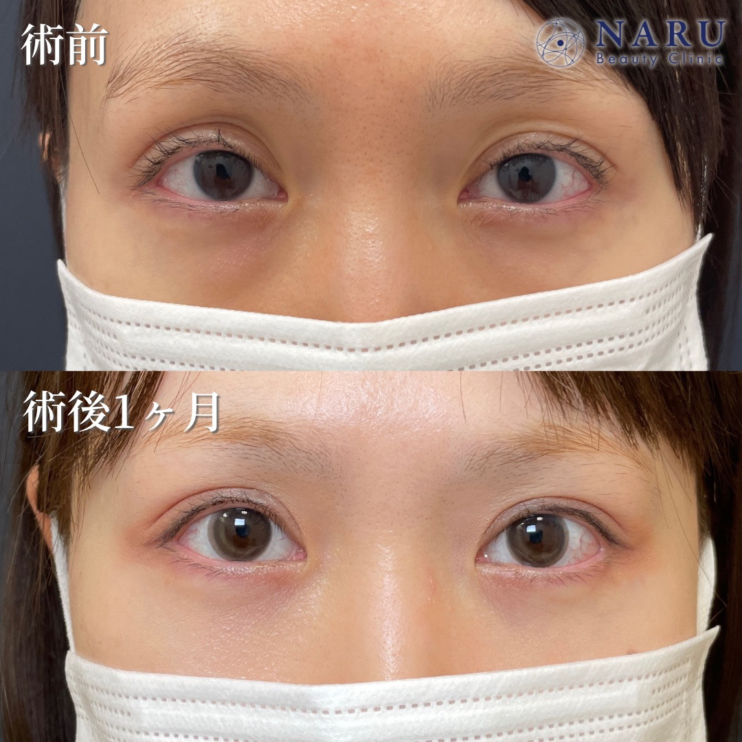 30代女性　切らない眼瞼下垂