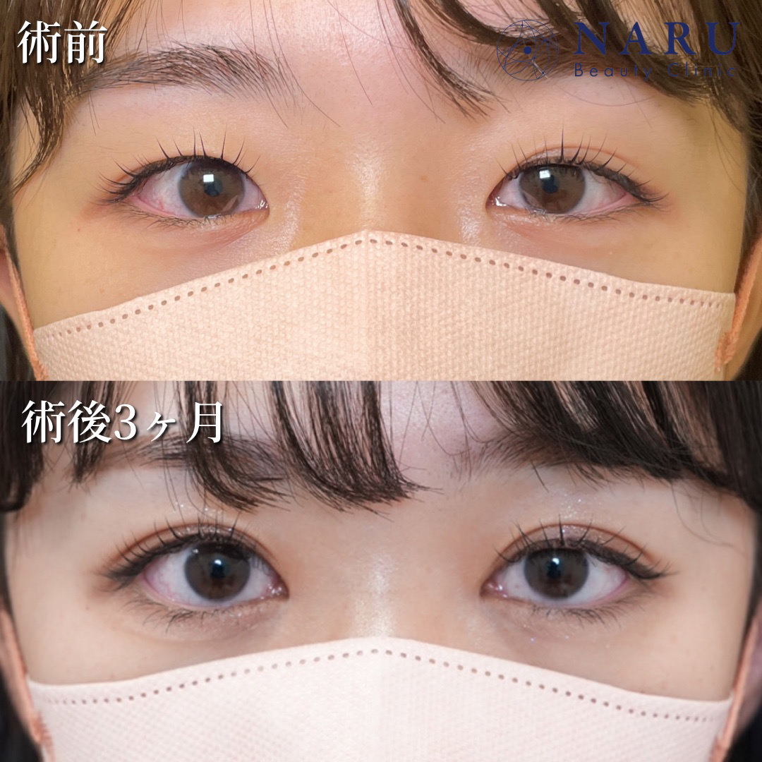 20代女性　二重埋没法＋目頭切開