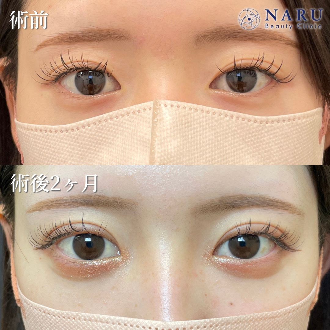 目元 凹凸のない目元の症例一覧 - 二重整形専門のNARU Beauty Clinic(ナルクリ)