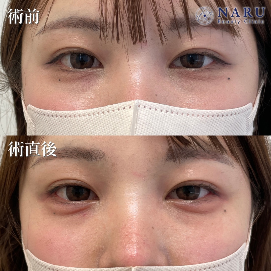 20代女性　涙袋ヒアルロン酸