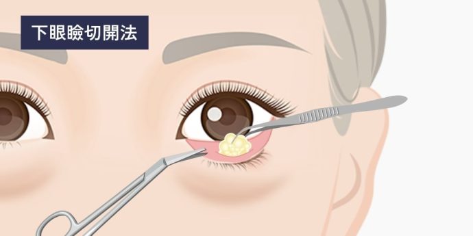 下眼瞼除皺術