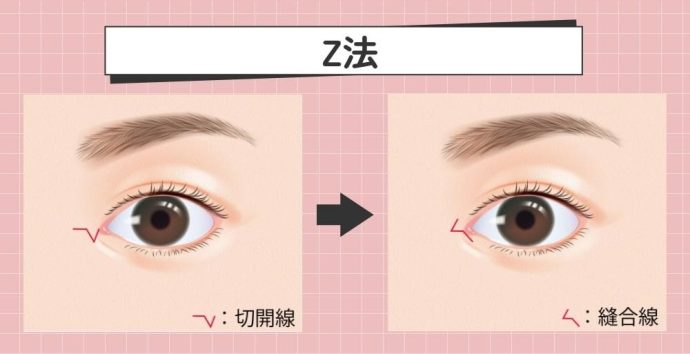 Z法