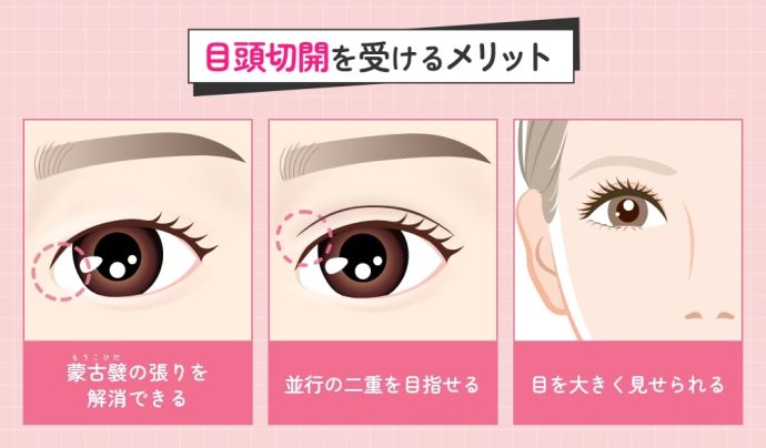目頭切開を受けるメリット