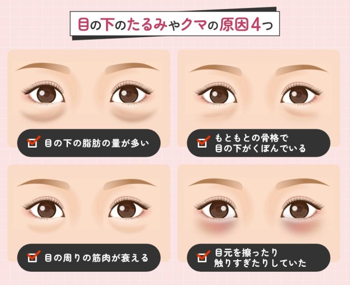 目の下のたるみやクマの原因4つ