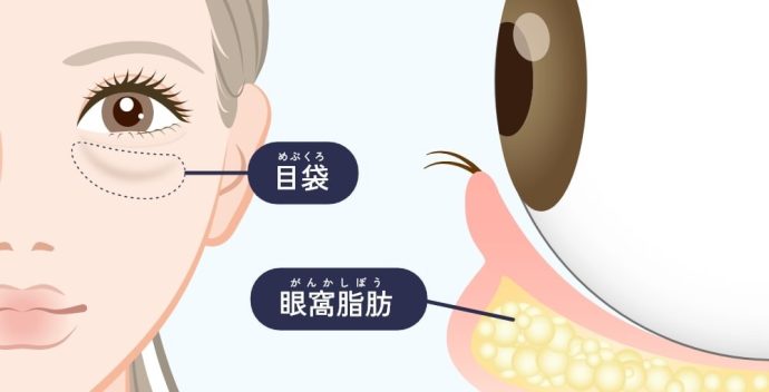 目の下の脂肪