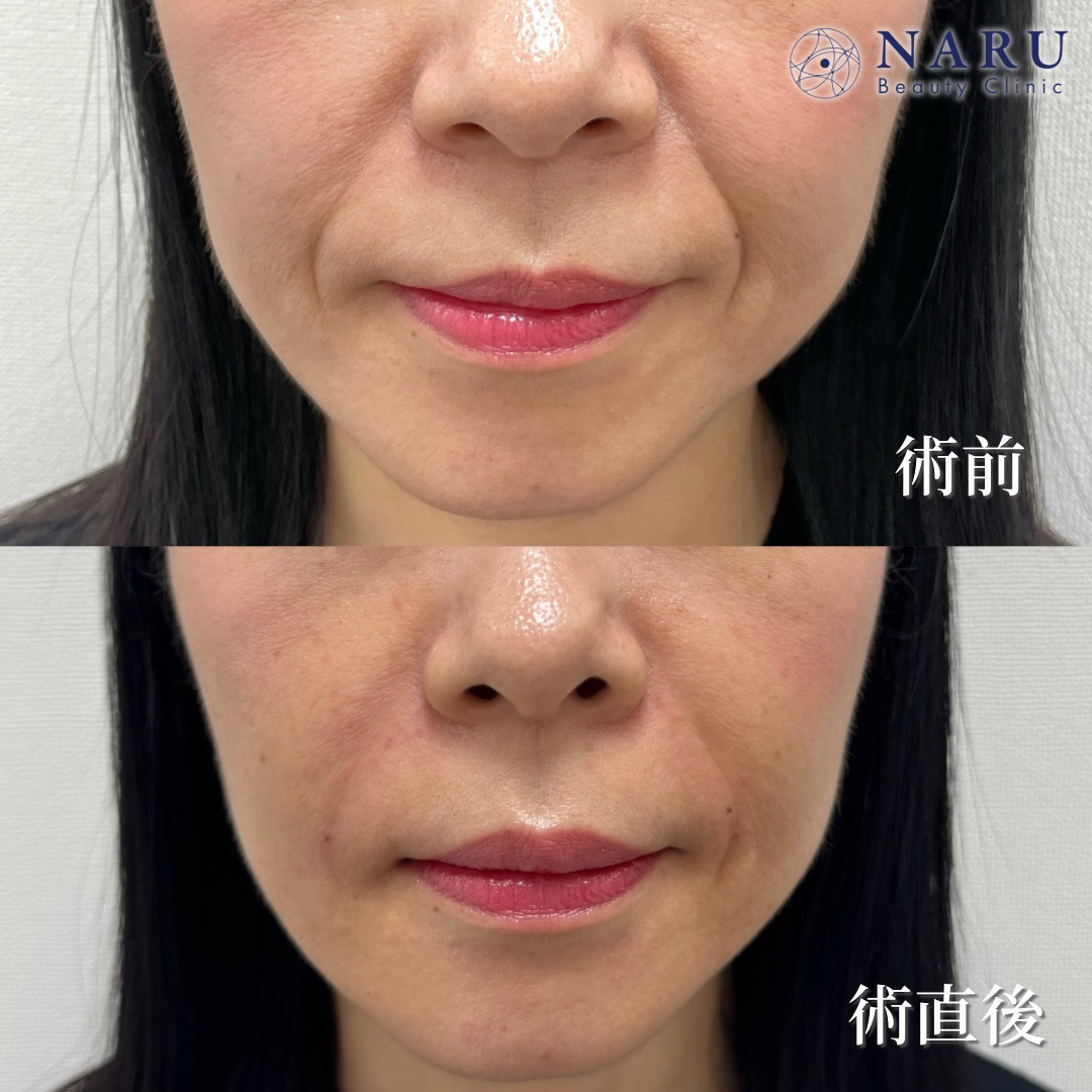 40代女性　ほうれい線ヒアルロン酸