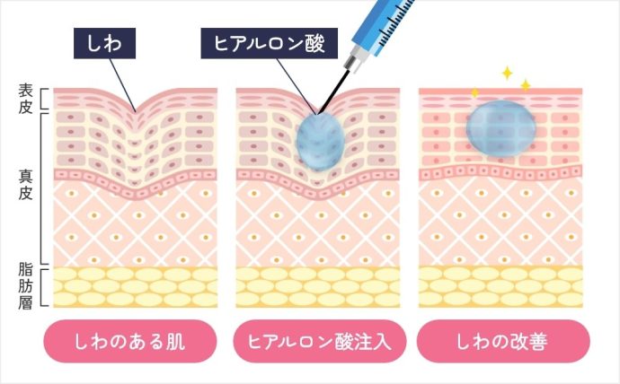 ヒアルロン酸注入