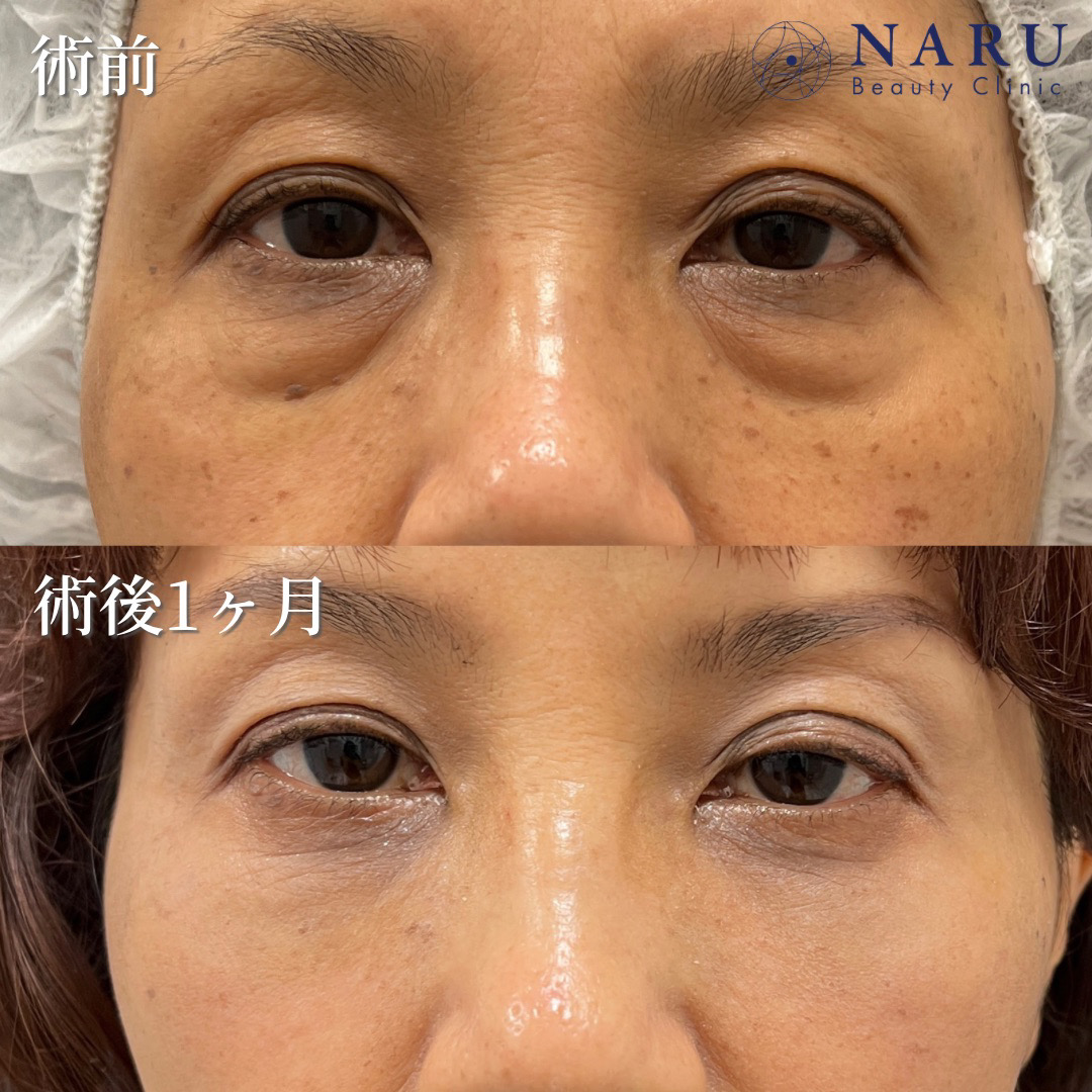 50代女性　クマ取り＋目の下の脂肪注入