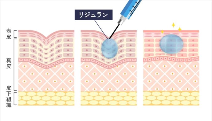 リジュランとは