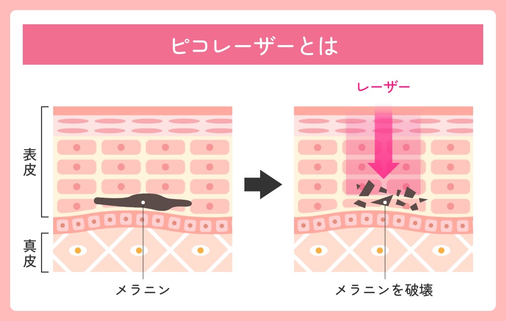 ピコレーザーとは