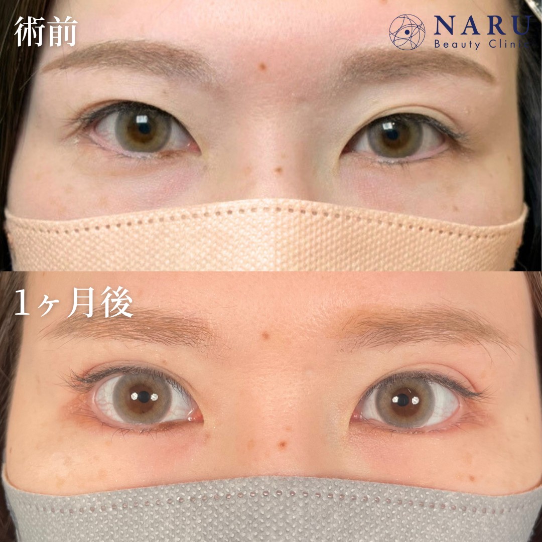 20代女性　二重整形　グラマラスライン形成