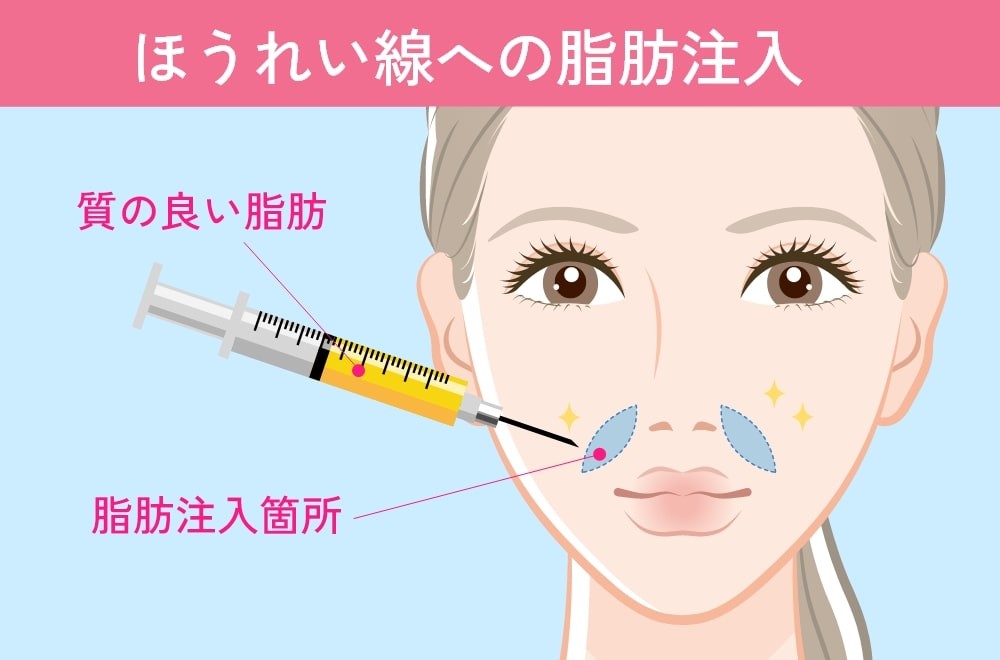 ほうれい線の脂肪注入