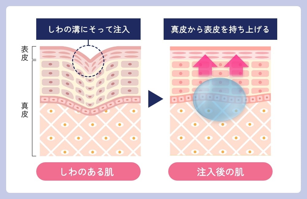 ヒアルロン酸注入
