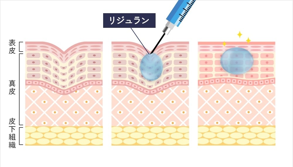 リジュラン（高濃度サーモン注射）