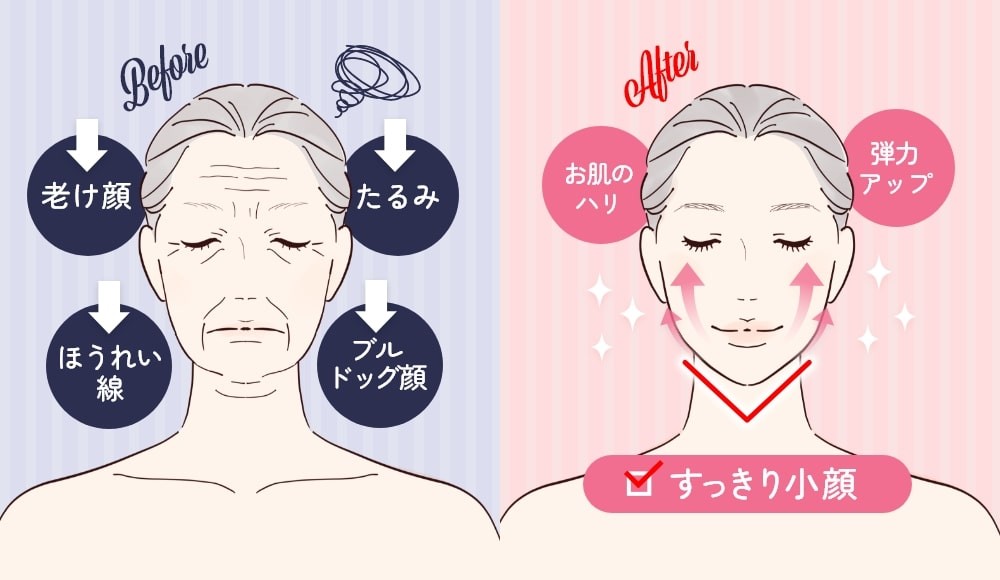 糸リフト