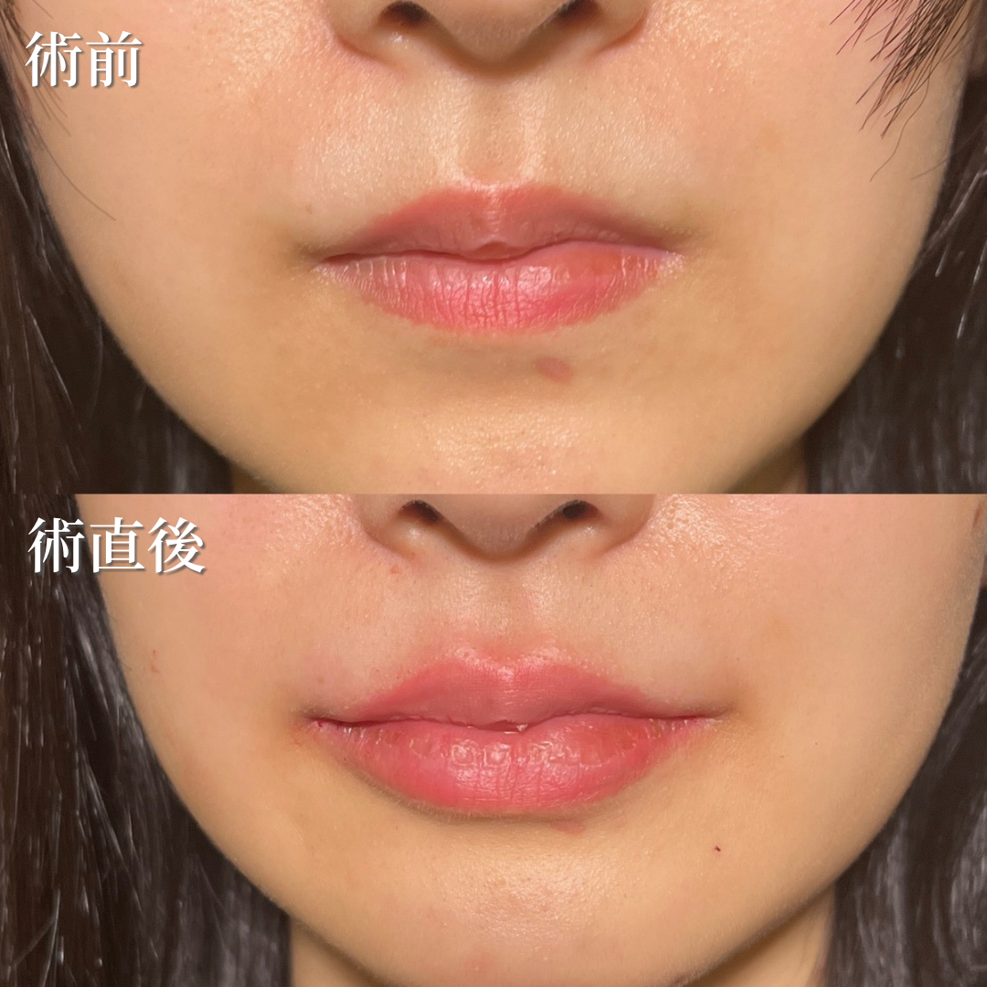 20代女性　唇ヒアルロン酸